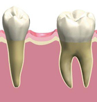 インプラントの構造