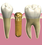 インプラントの構造