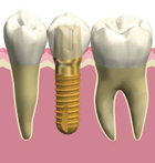 インプラントの構造