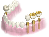 岐阜県揖斐郡大野町黒野 ほさか歯科:インプラント