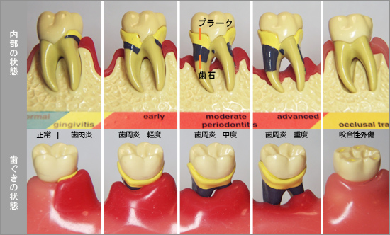 岐阜県揖斐郡大野町黒野 ほさか歯科:歯周病