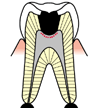 むし歯C1